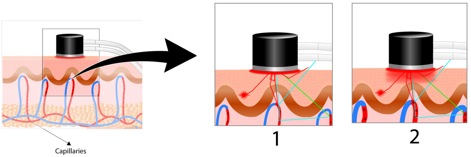 Láser Doppler Controlado con Calor - ilustración